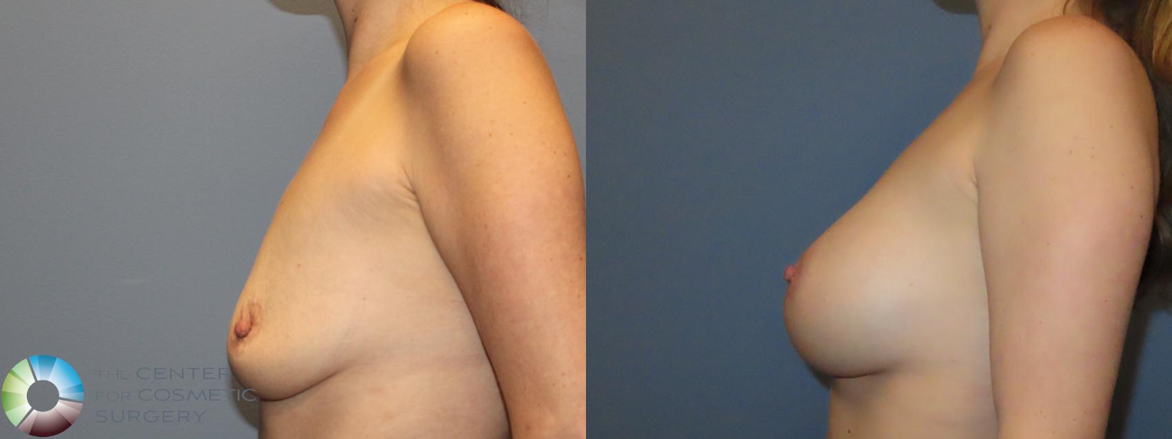 Before & After Breast Augmentation Case 12125 Left Side in Denver and Colorado Springs, CO