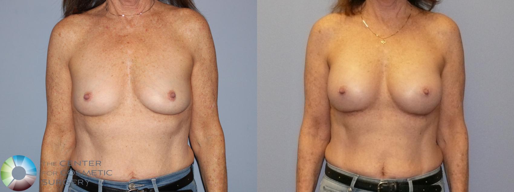 Before & After Breast Augmentation Case 12128 Front in Denver and Colorado Springs, CO