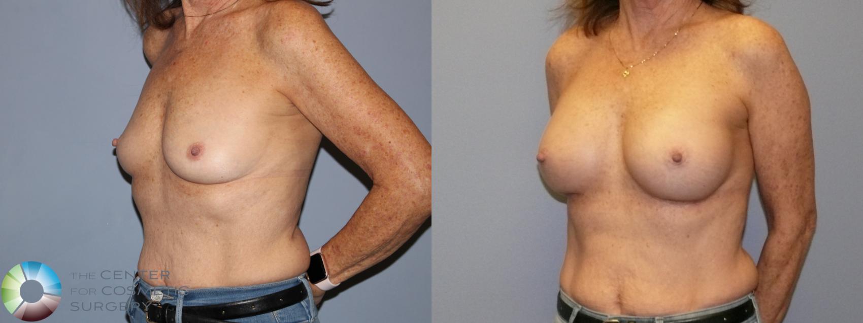Before & After Breast Augmentation Case 12128 Left Oblique in Denver and Colorado Springs, CO