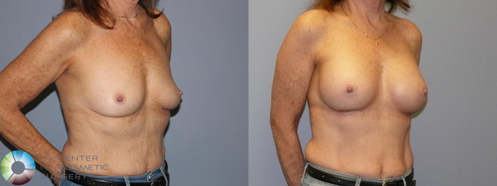 Before & After Breast Augmentation Case 12128 Right Oblique in Denver and Colorado Springs, CO