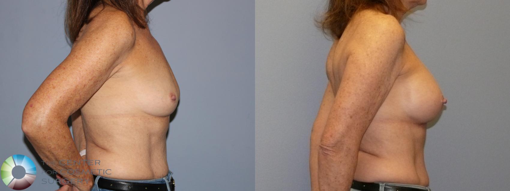 Before & After Breast Augmentation Case 12128 Right Side in Denver and Colorado Springs, CO
