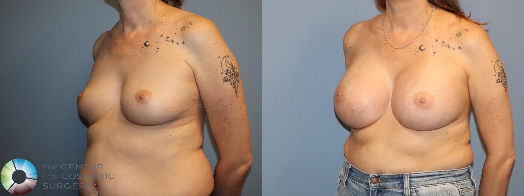 Before & After Breast Augmentation Case 12129 Left Oblique in Denver and Colorado Springs, CO