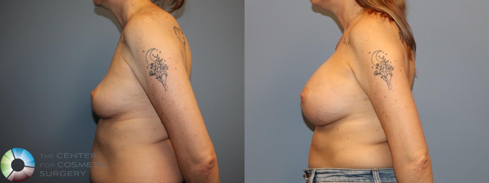 Before & After Breast Augmentation Case 12129 Left Side in Denver and Colorado Springs, CO
