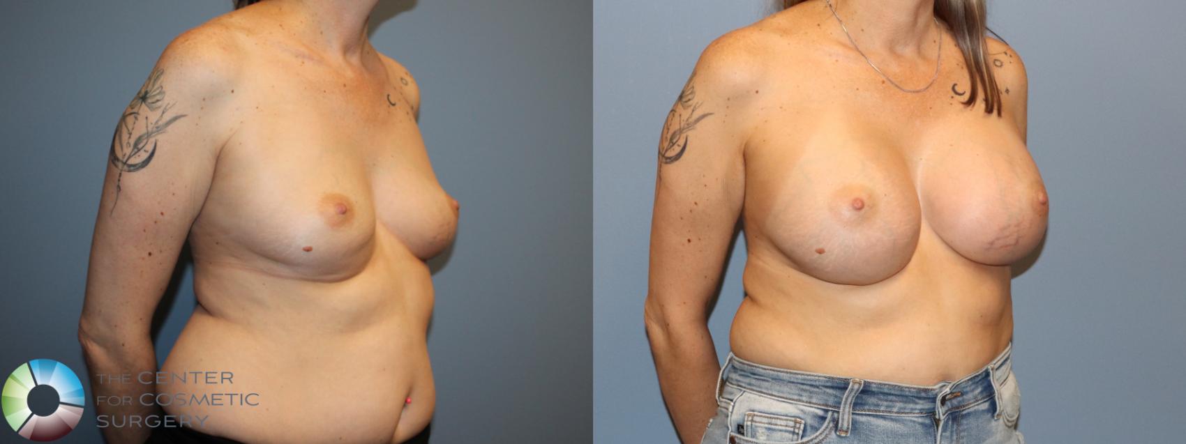 Before & After Breast Augmentation Case 12129 Right Oblique in Denver and Colorado Springs, CO