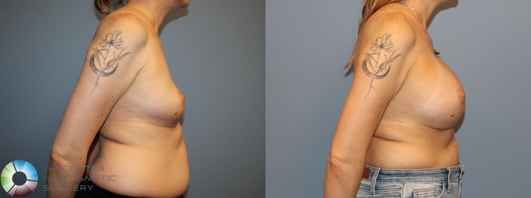 Before & After Breast Augmentation Case 12129 Right Side in Denver and Colorado Springs, CO