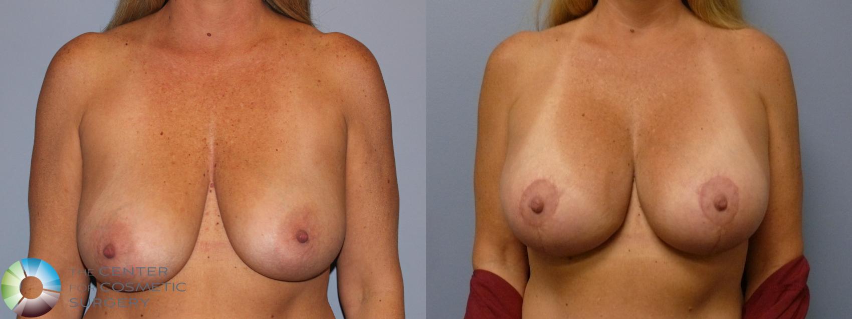 Before & After Breast Augmentation Case 12134 Front in Denver and Colorado Springs, CO
