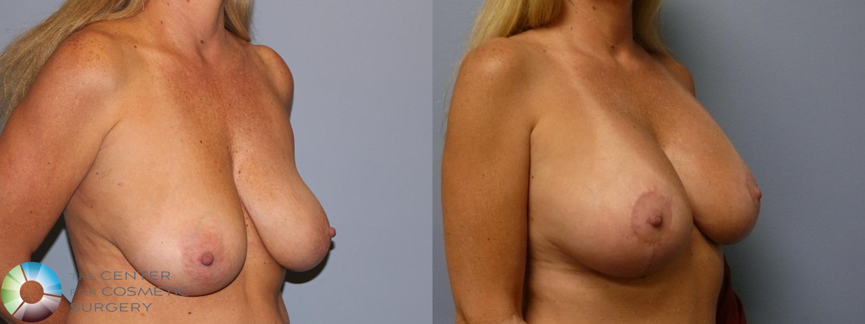 Before & After Breast Augmentation Case 12134 Right Oblique in Denver and Colorado Springs, CO