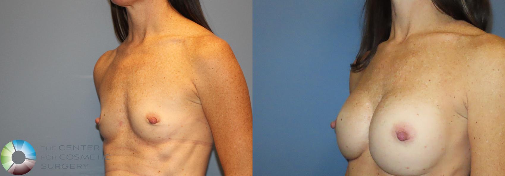 Before & After Breast Augmentation Case 12135 Left Oblique in Denver and Colorado Springs, CO