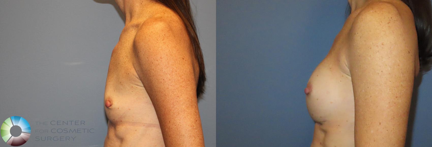 Before & After Breast Augmentation Case 12135 Left Side in Denver and Colorado Springs, CO