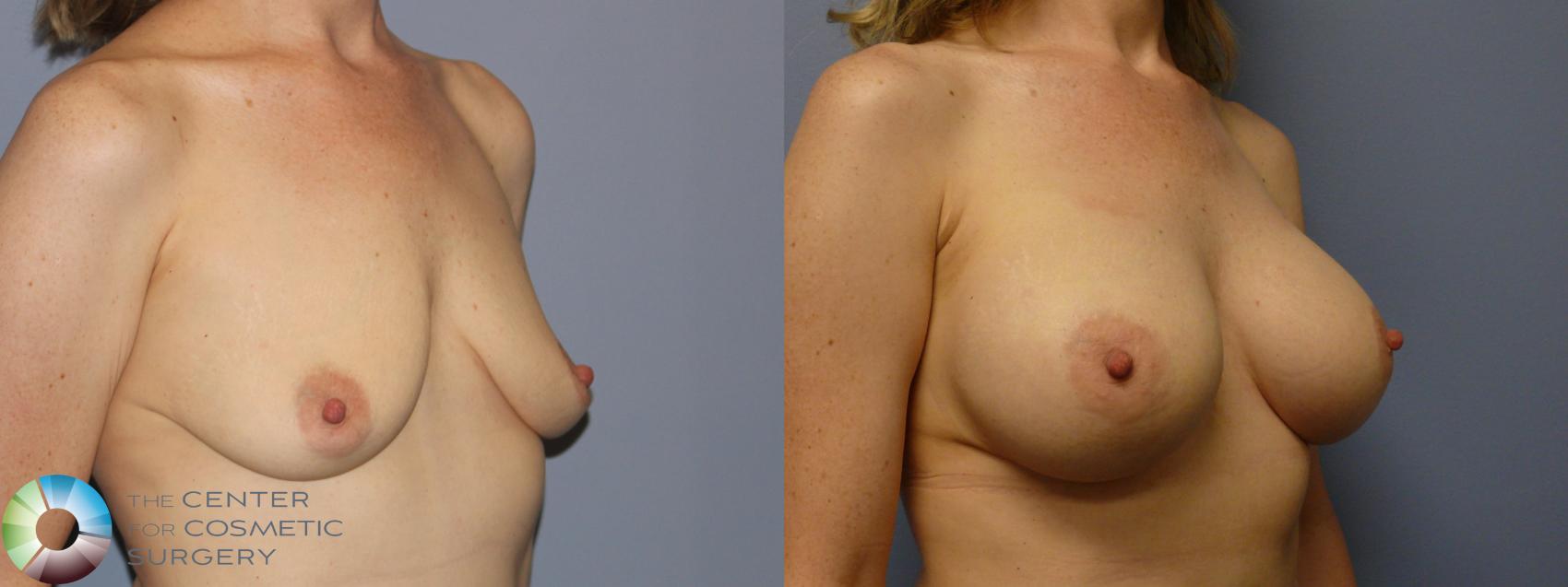 Before & After Breast Augmentation Case 12136 Left Side in Denver and Colorado Springs, CO