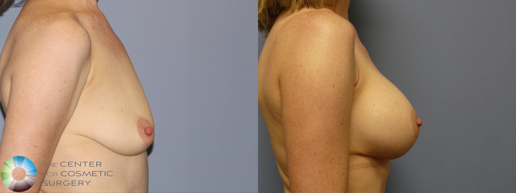 Before & After Breast Augmentation Case 12136 Right Side in Denver and Colorado Springs, CO