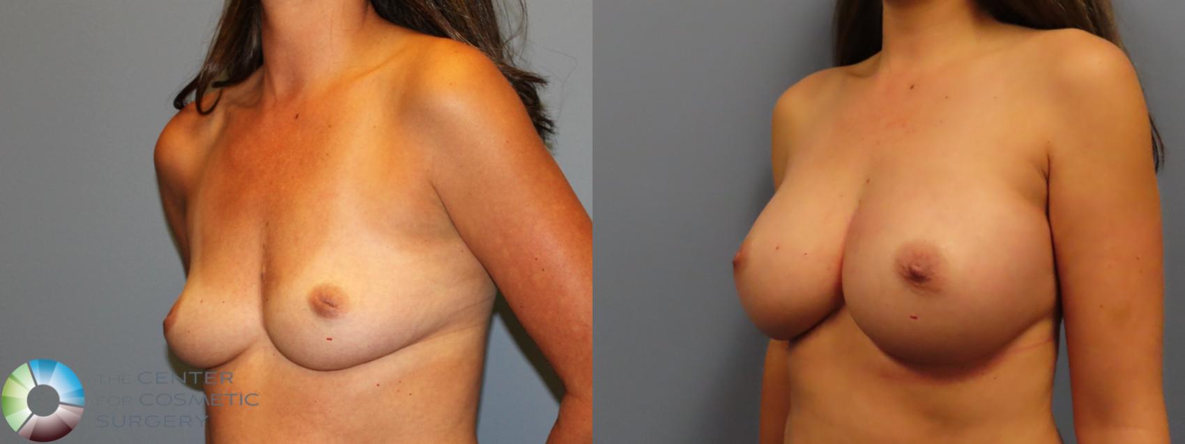 Before & After Breast Augmentation Case 12137 Left Oblique in Denver and Colorado Springs, CO