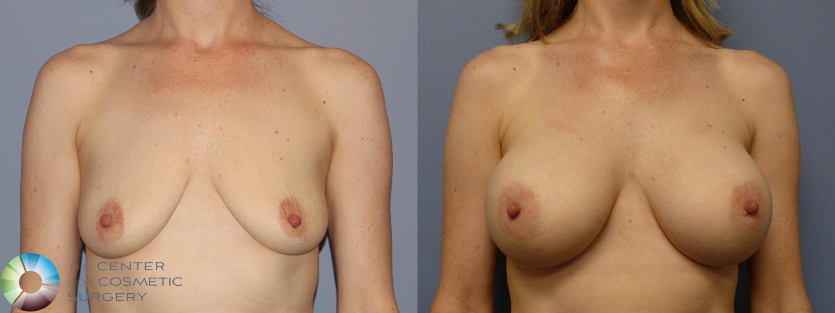 Before & After Breast Augmentation Case 12141 Front in Denver and Colorado Springs, CO