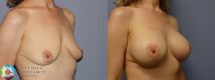 Best Denver Breast Augmentation/Implants
