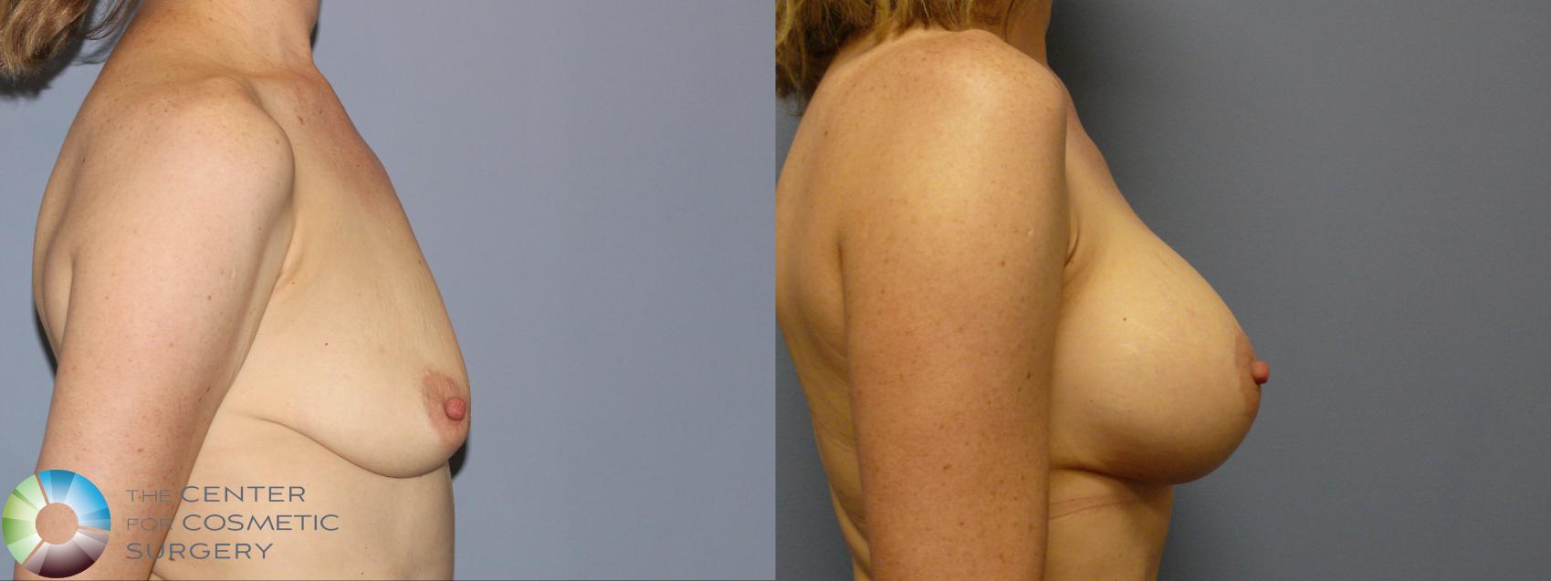Before & After Breast Augmentation Case 12141 Right Side in Denver and Colorado Springs, CO