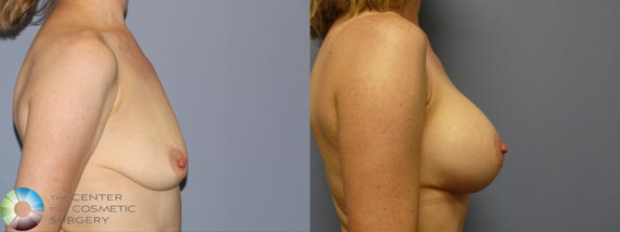 Best Denver Breast Augmentation/Implants