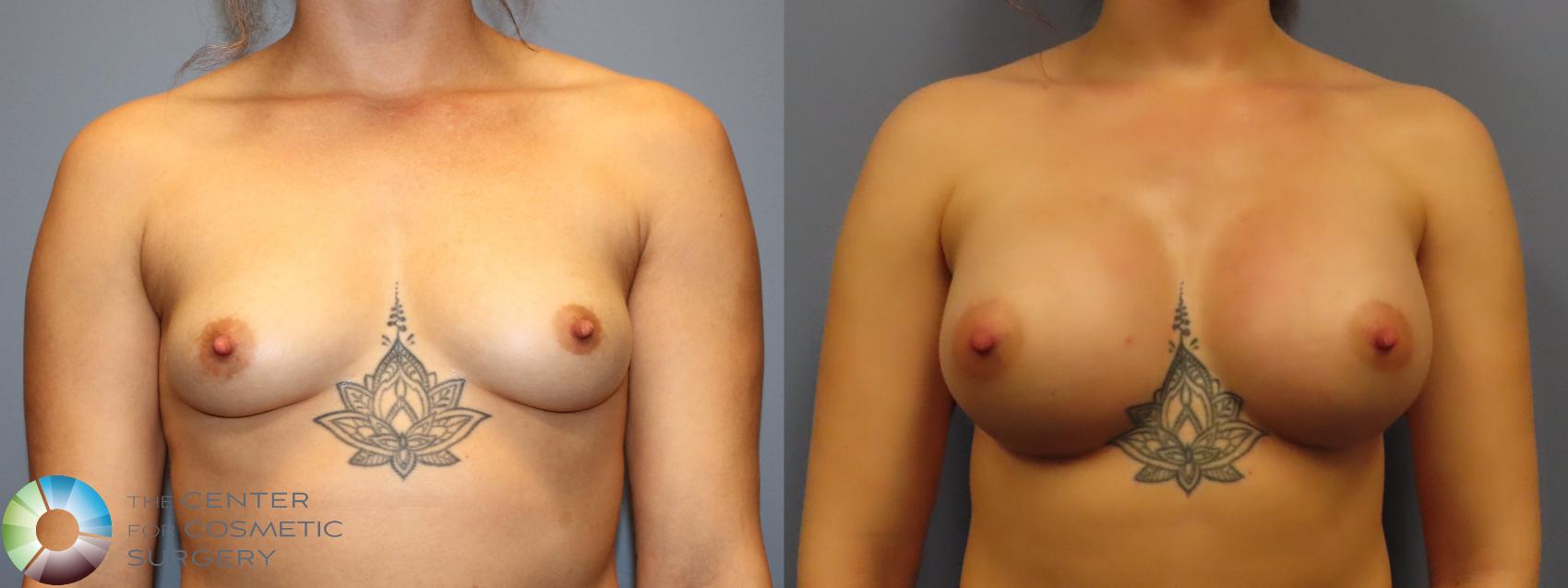 Best Denver Breast Augmentation/Implants
