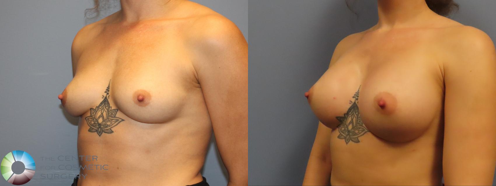 Before & After Breast Augmentation Case 12142 Left Oblique in Denver and Colorado Springs, CO
