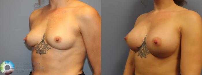 Best Denver Breast Augmentation/Implants