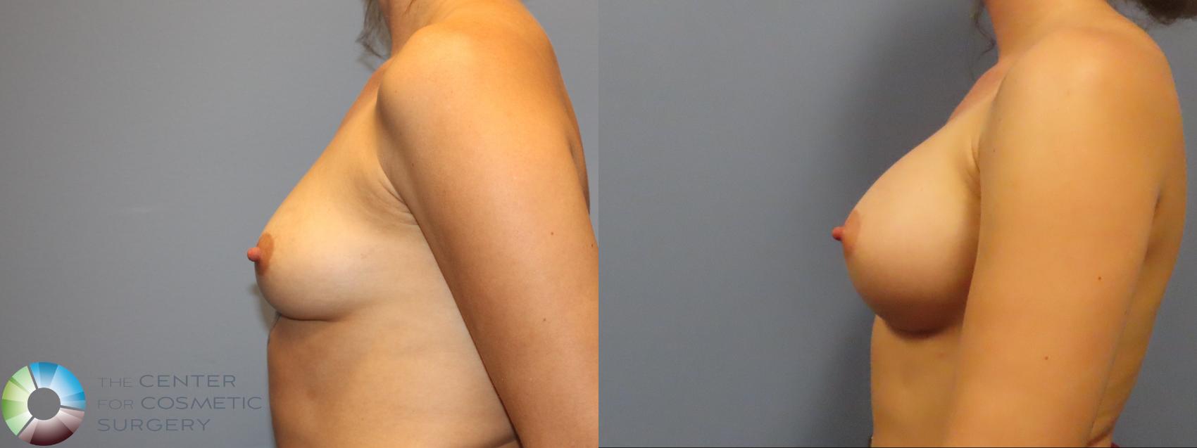 Before & After Breast Augmentation Case 12142 Left Side in Denver and Colorado Springs, CO