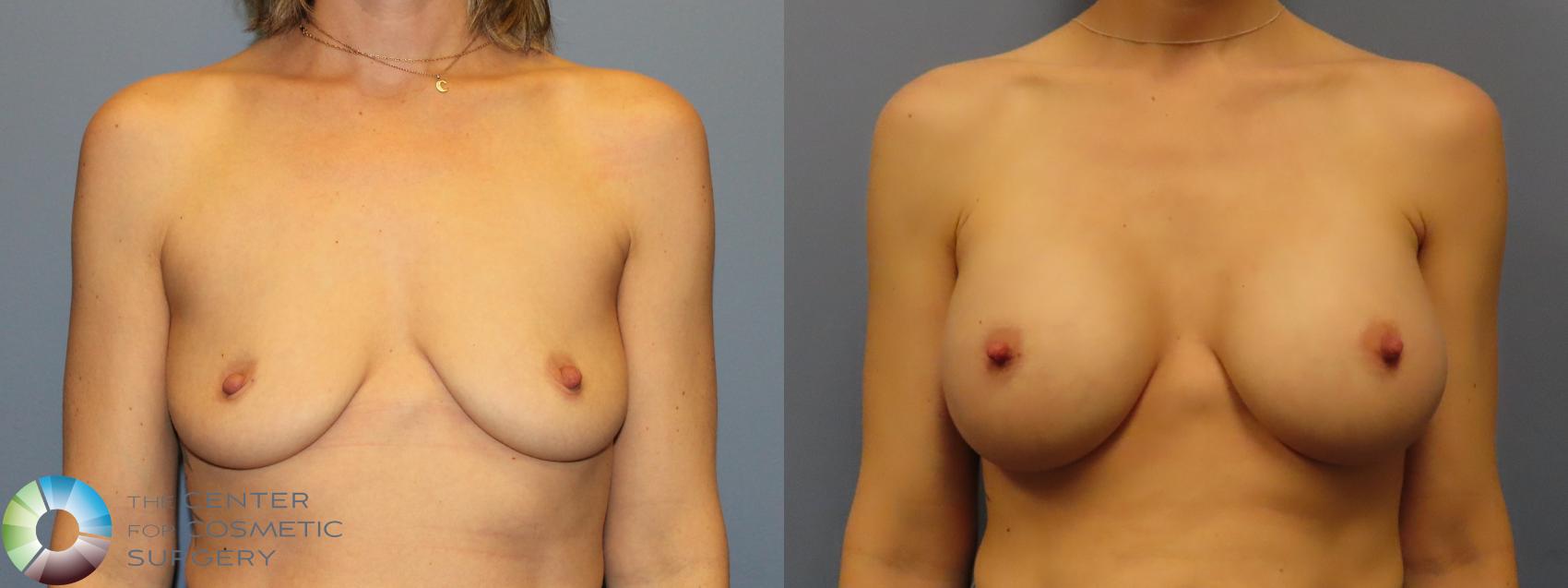 Before & After Breast Augmentation Case 12143 Front in Denver and Colorado Springs, CO