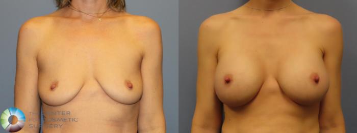 Best Denver Breast Augmentation/Implants