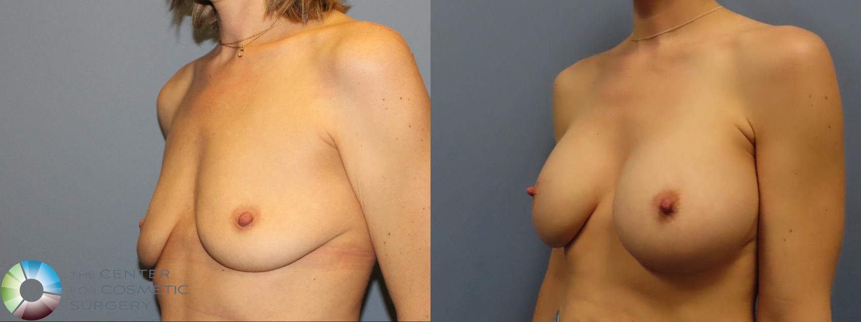 Best Denver Breast Augmentation/Implants