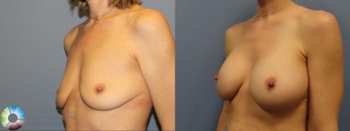 Best Denver Breast Augmentation/Implants