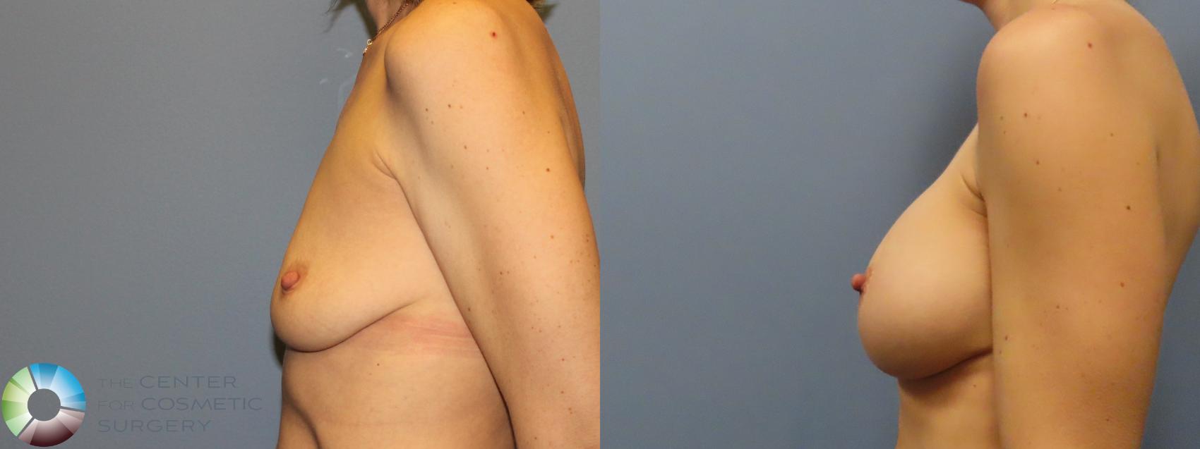 Before & After Breast Augmentation Case 12143 Left Side in Denver and Colorado Springs, CO