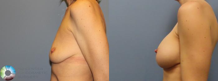 Best Denver Breast Augmentation/Implants