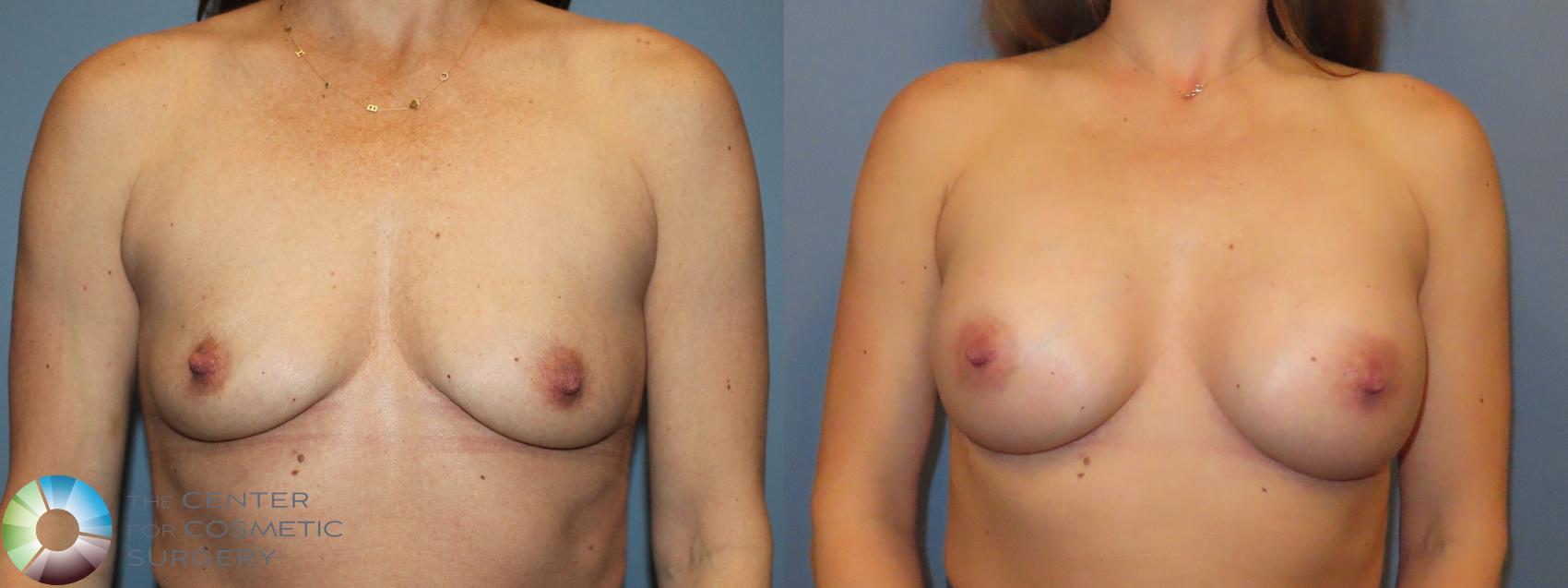 Before & After Breast Augmentation Case 12154 Front in Denver and Colorado Springs, CO