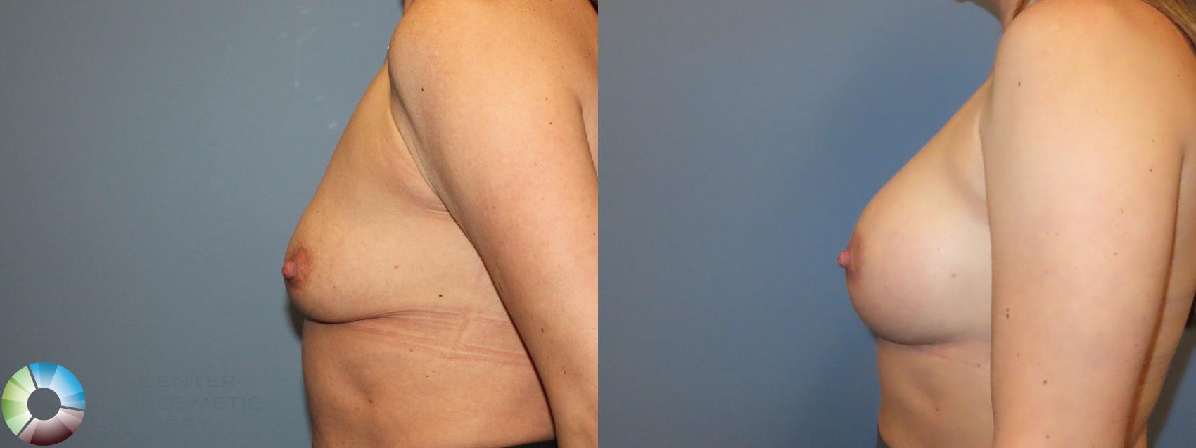 Before & After Breast Augmentation Case 12154 Left Side in Denver and Colorado Springs, CO