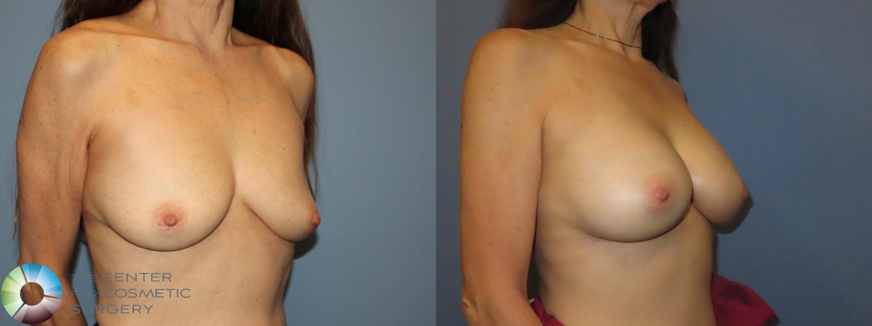 Before & After Breast Augmentation Case 12155 Right Oblique in Denver and Colorado Springs, CO