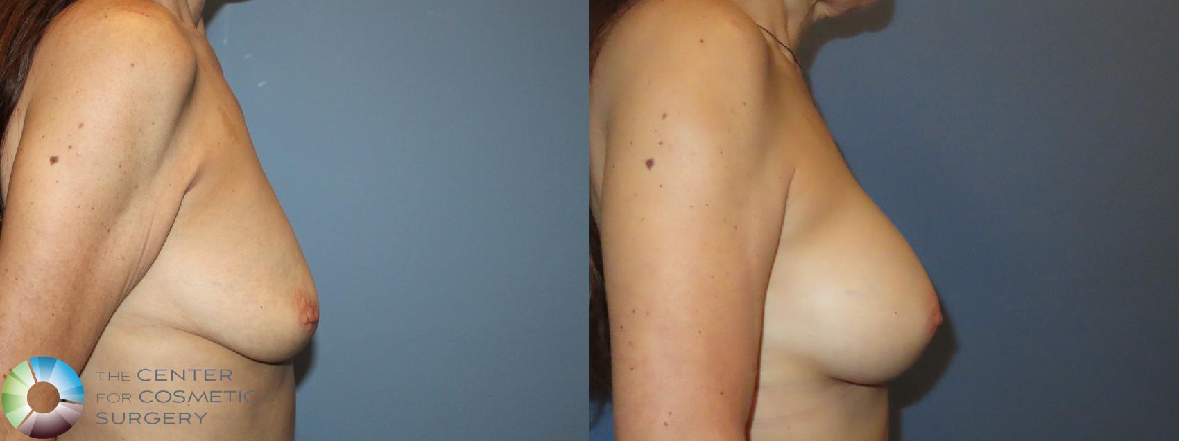 Before & After Breast Augmentation Case 12155 Right Side in Denver and Colorado Springs, CO