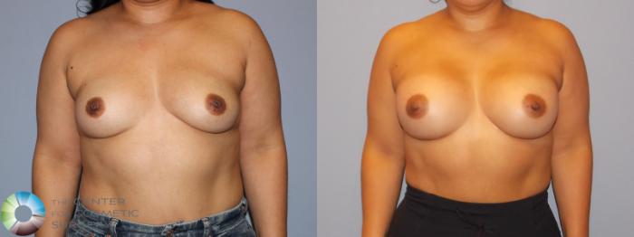 Before & After Motiva Implants® Case 12158 Front in Denver and Colorado Springs, CO