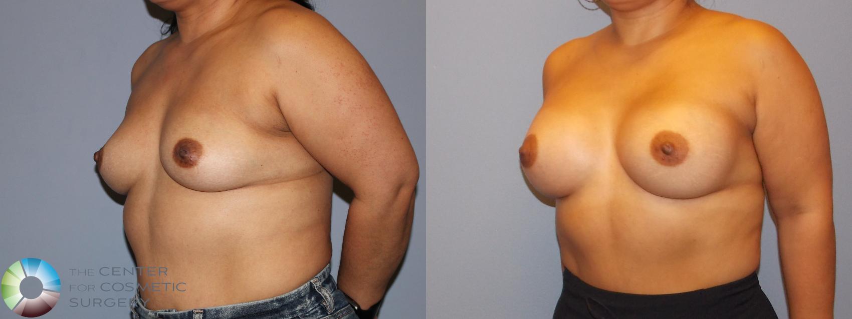 Before & After Breast Augmentation Case 12158 Left Oblique in Denver and Colorado Springs, CO