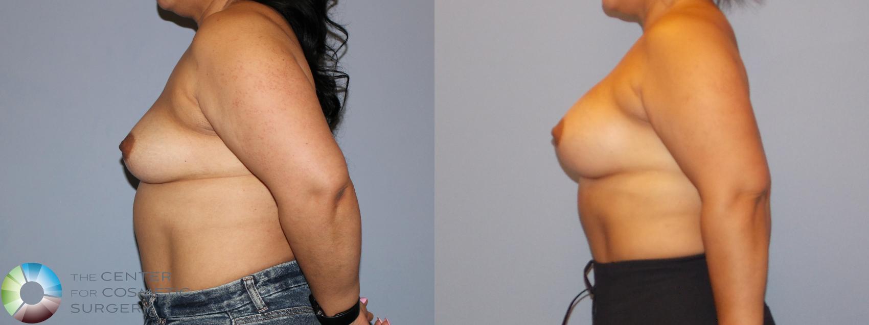 Before & After Breast Augmentation Case 12158 Left Side in Denver and Colorado Springs, CO