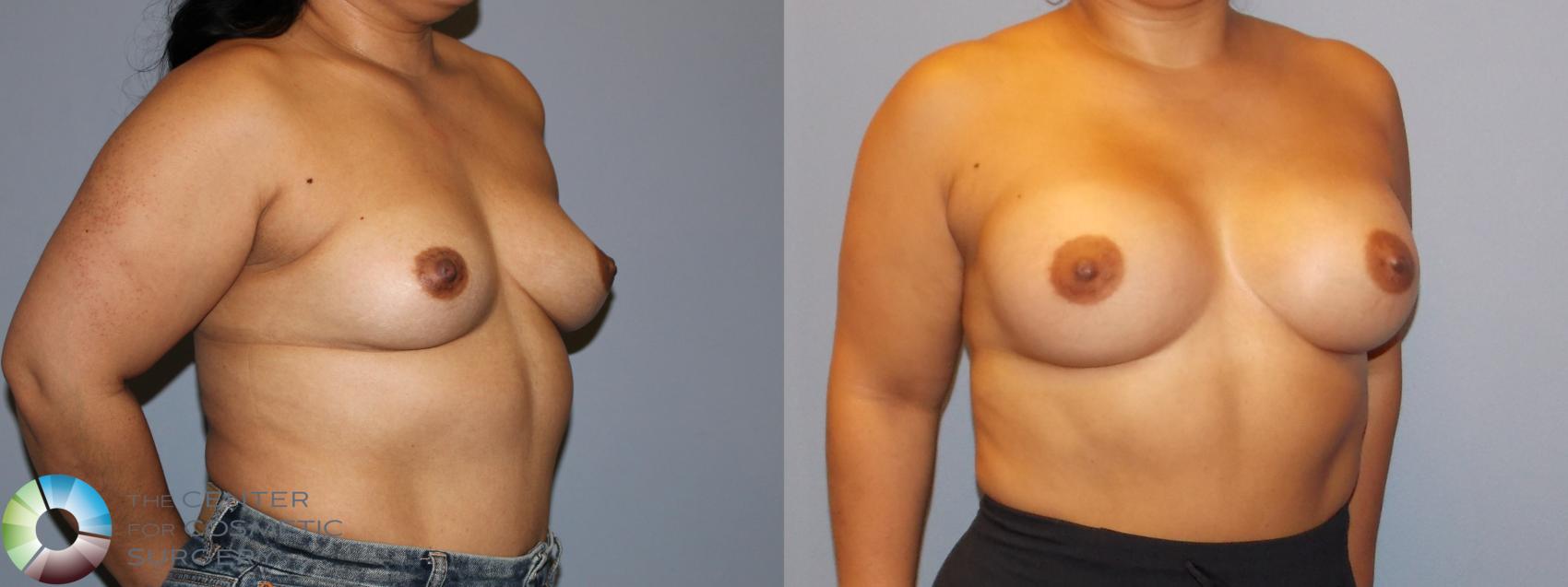 Before & After Breast Augmentation Case 12158 Right Oblique in Denver and Colorado Springs, CO