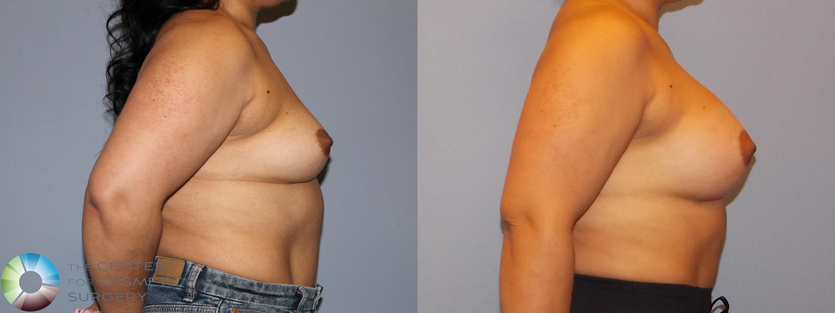 Before & After Breast Augmentation Case 12158 Right Side in Denver and Colorado Springs, CO