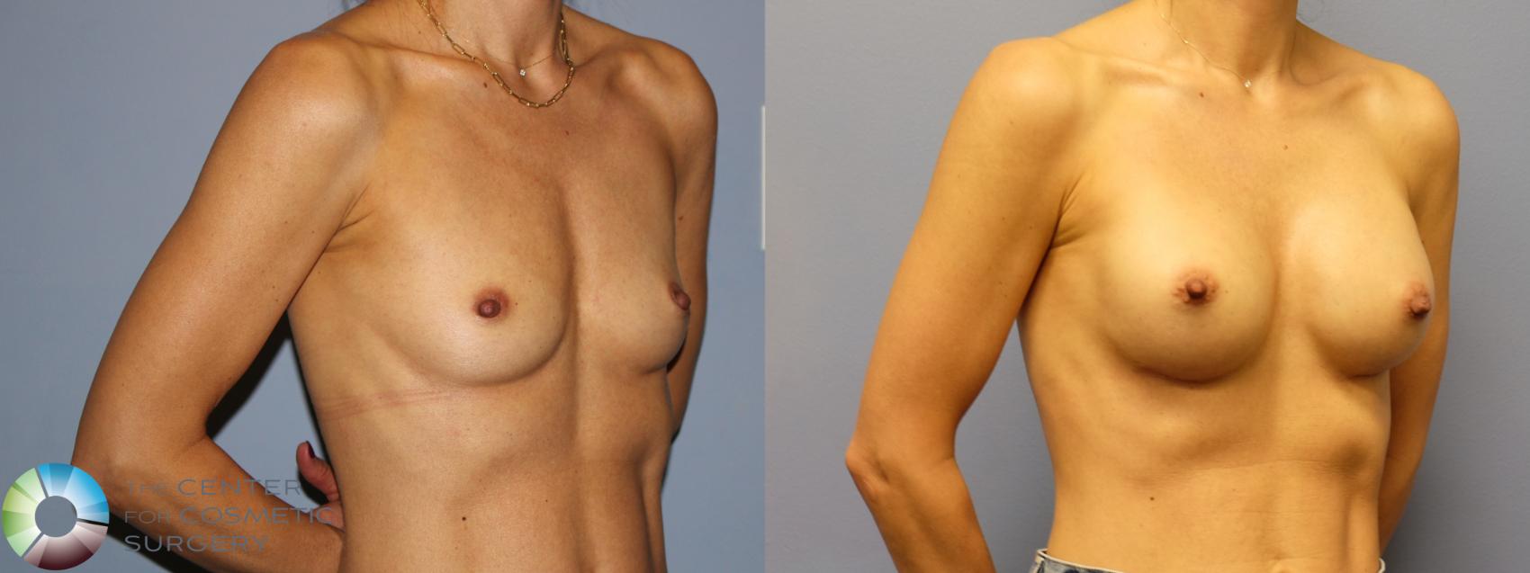 Before & After Breast Augmentation Case 12160 Left Oblique in Denver and Colorado Springs, CO