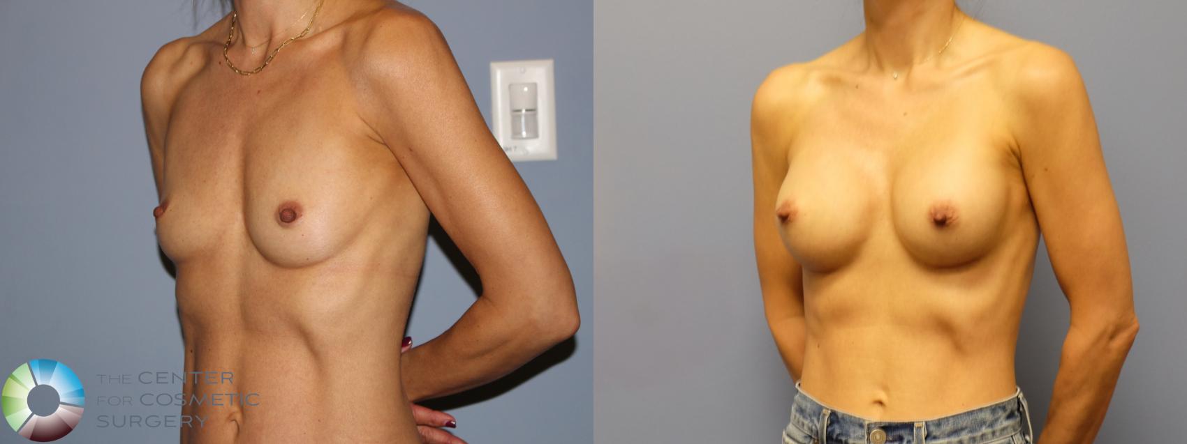 Before & After Breast Augmentation Case 12160 Right Oblique in Denver and Colorado Springs, CO