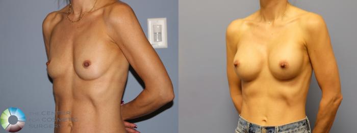 Before & After Motiva Implants® Case 12160 Right Oblique in Denver and Colorado Springs, CO