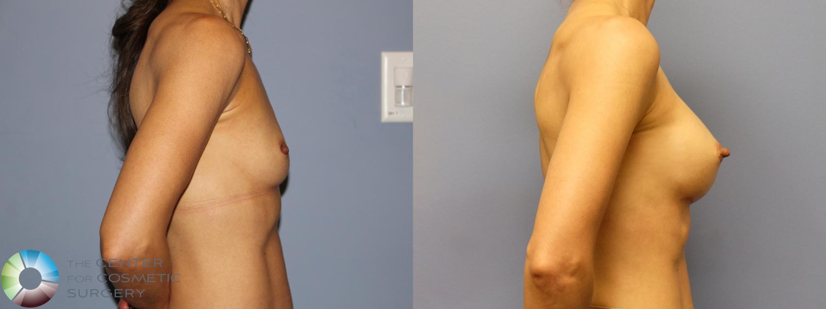 Before & After Breast Augmentation Case 12160 Right Side in Denver and Colorado Springs, CO