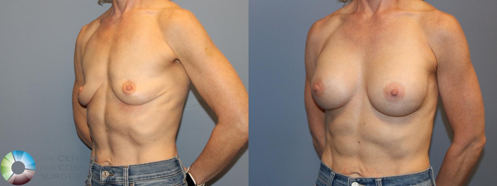 Before & After Breast Augmentation Case 12167 Left Oblique in Denver and Colorado Springs, CO