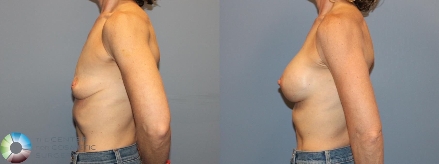 Before & After Breast Augmentation Case 12167 Left Side in Denver and Colorado Springs, CO