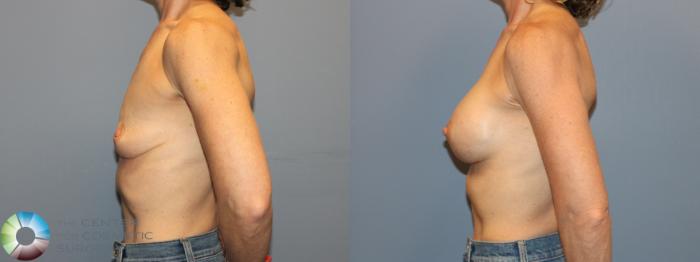 Before & After Motiva Implants® Case 12167 Left Side in Denver and Colorado Springs, CO