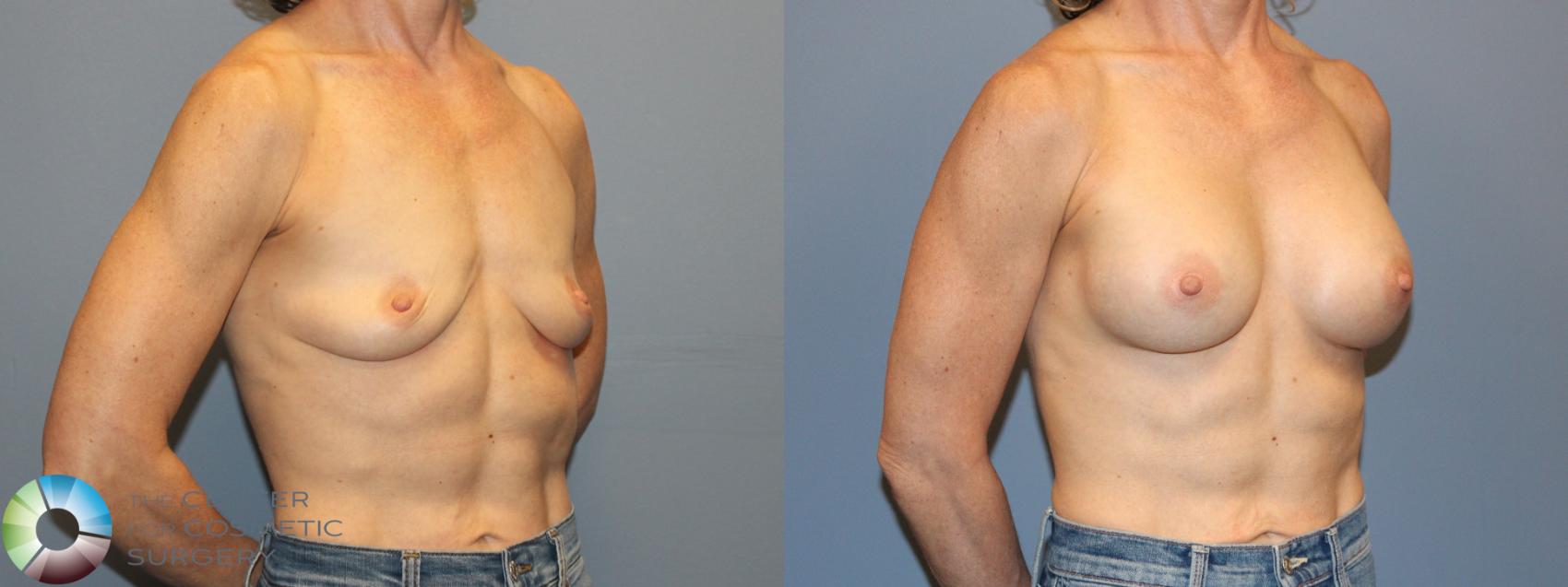 Before & After Breast Augmentation Case 12167 Right Oblique in Denver and Colorado Springs, CO