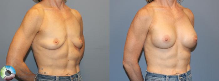 Before & After Motiva Implants® Case 12167 Right Oblique in Denver and Colorado Springs, CO