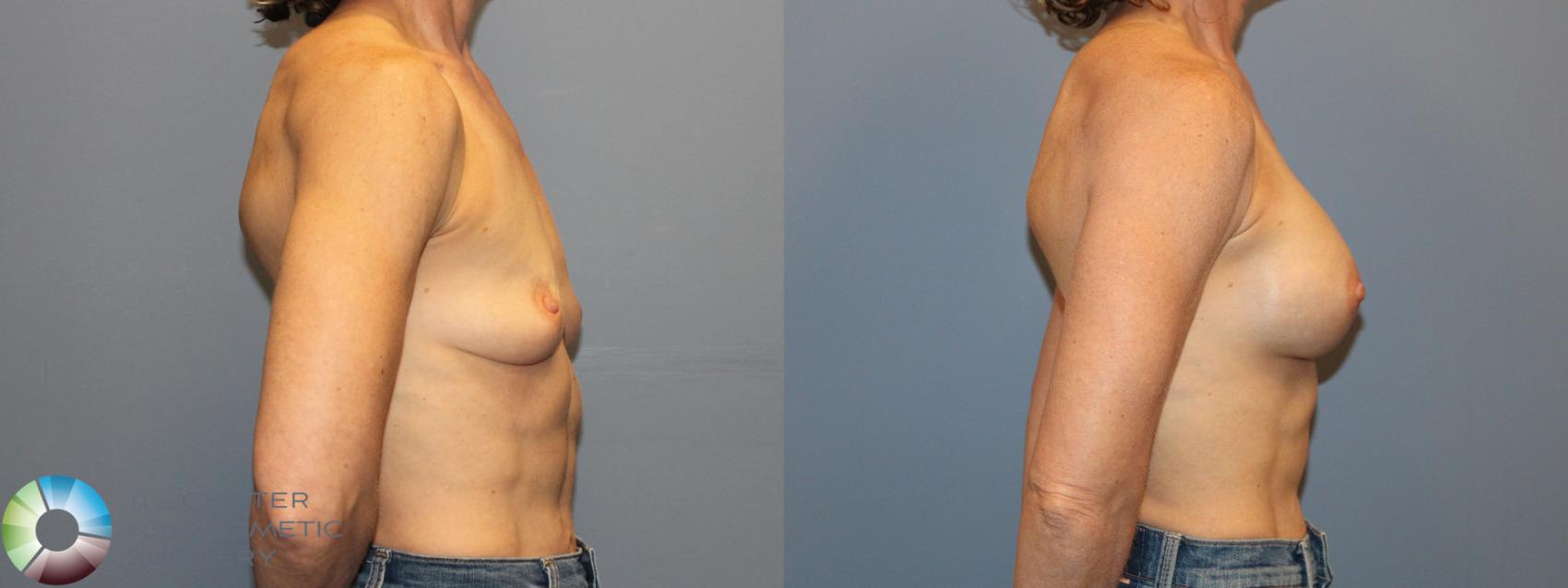 Before & After Breast Augmentation Case 12167 Right Side in Denver and Colorado Springs, CO