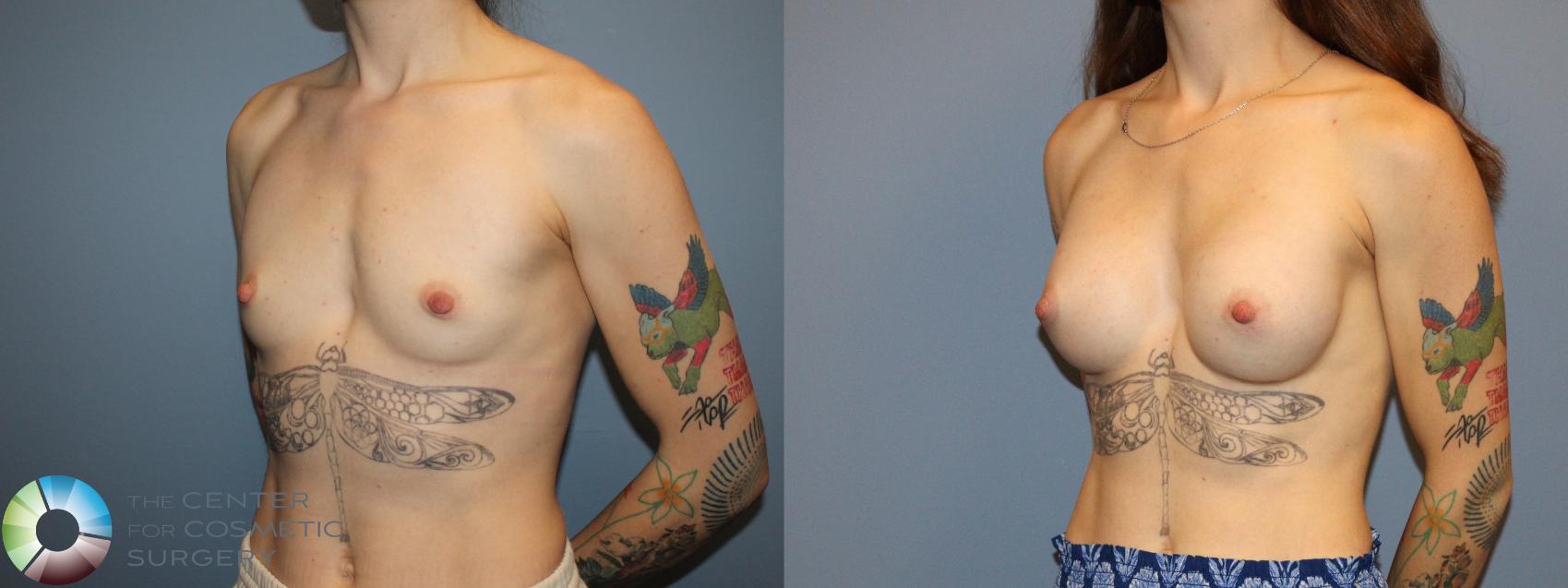 Before & After Breast Augmentation Case 12172 Left Oblique in Denver and Colorado Springs, CO